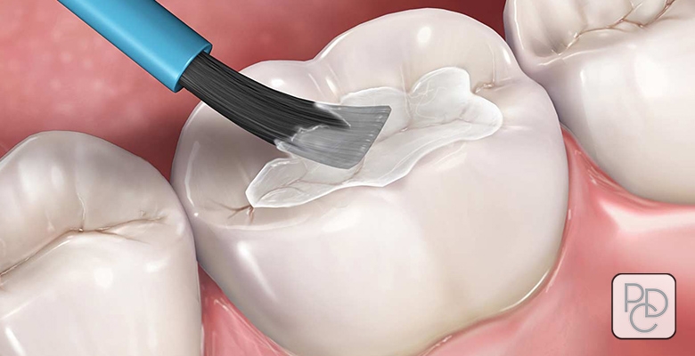 What Are Dental Sealants