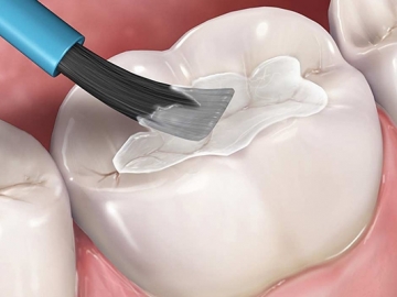 What Are Dental Sealants